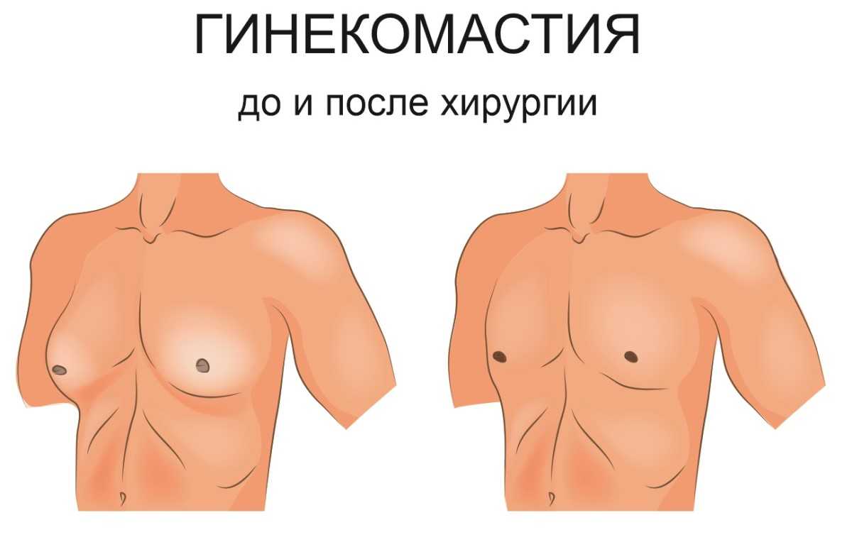 причины болезни груди у мужчин фото 28
