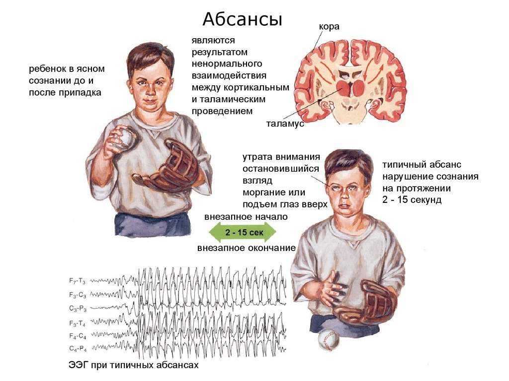 Эпилепсия. лечение эпилепсии у взрослых и детей